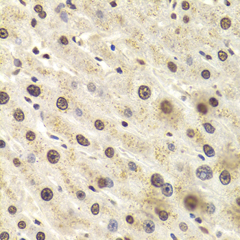 HNRNPD / AUF1 Antibody - Immunohistochemistry of paraffin-embedded Human liver injury tissue.