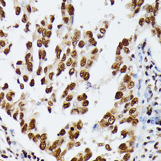 HNRNPD / AUF1 Antibody - Immunohistochemistry of paraffin-embedded Human lung cancer using HNRNPD Polyclonal Antibody at dilution of 1:100 (40x lens).
