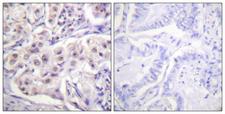 HNRNPD / AUF1 Antibody - Peptide - + Immunohistochemistry analysis of paraffin-embedded human lung carcinoma tissue using hnRPD (Ab-83) antibody.
