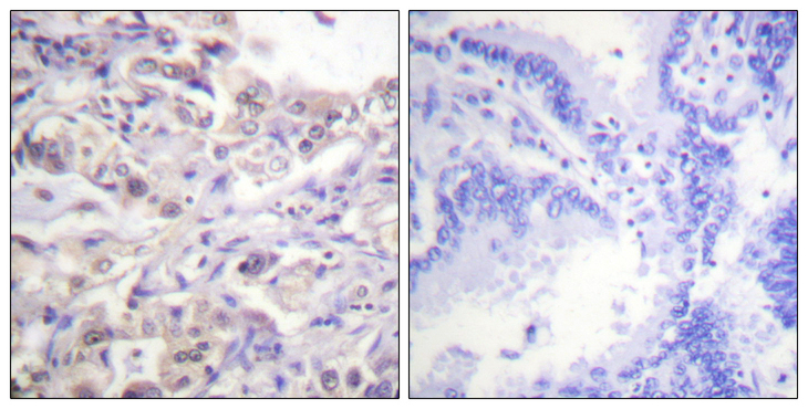 HNRNPD / AUF1 Antibody - Immunohistochemistry analysis of paraffin-embedded human lung carcinoma, using hnRPD (Phospho-Ser83) Antibody. The picture on the right is blocked with the phospho peptide.