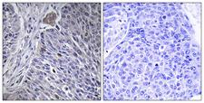 HNRNPDL / hnRNP D Antibody - Peptide - + Immunohistochemistry analysis of paraffin-embedded human lung carcinoma tissue using HNRPDL antibody.