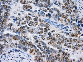 HNRNPF / hnRNP F Antibody - Immunohistochemical staining of paraffin-embedded Adenocarcinoma of Human ovary tissue using anti-HNRNPF mouse monoclonal antibody.