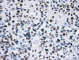 HNRNPF / hnRNP F Antibody - Immunohistochemical staining of paraffin-embedded Carcinoma of Human bladder tissue using anti-HNRNPF mouse monoclonal antibody.
