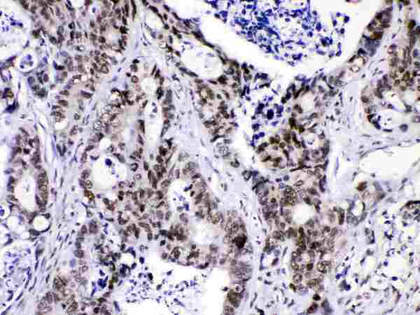HNRNPF / hnRNP F Antibody - HnRNPF was detected in paraffin-embedded sections of human intetsinal cancer tissues using rabbit anti- HnRNPF Antigen Affinity purified polyclonal antibody