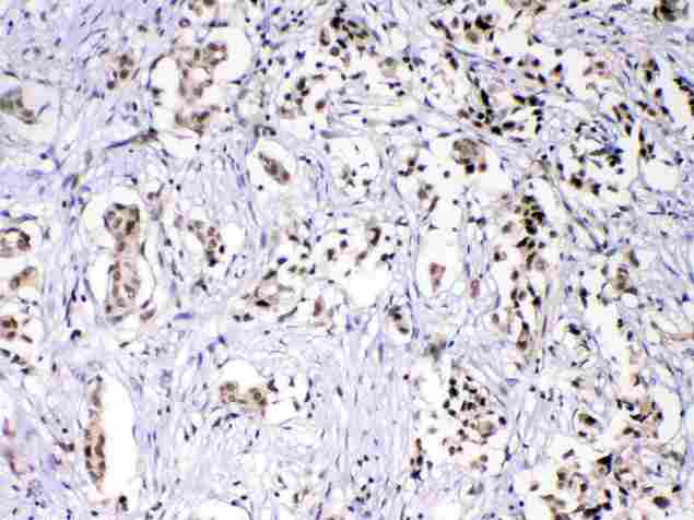 HNRNPF / hnRNP F Antibody - HnRNPF was detected in paraffin-embedded sections of human mammary cancer tissues using rabbit anti- HnRNPF Antigen Affinity purified polyclonal antibody