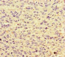 HNRNPF / hnRNP F Antibody - Immunohistochemistry of paraffin-embedded human melanoma cancer at dilution of 1:100