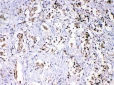 HNRNPF / hnRNP F Antibody - IHC testing of FFPE human breast cancer with hnRNP F antibody at 1ug/ml. HIER: steam section in pH6 citrate buffer for 20 min.