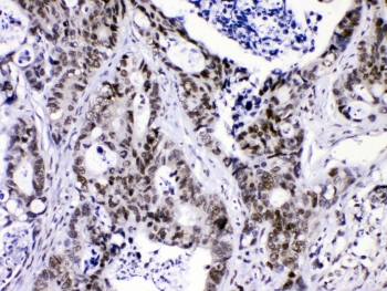 HNRNPF / hnRNP F Antibody - IHC testing of FFPE human intestinal cancer with hnRNP F antibody at 1ug/ml. HIER: steam section in pH6 citrate buffer for 20 min.
