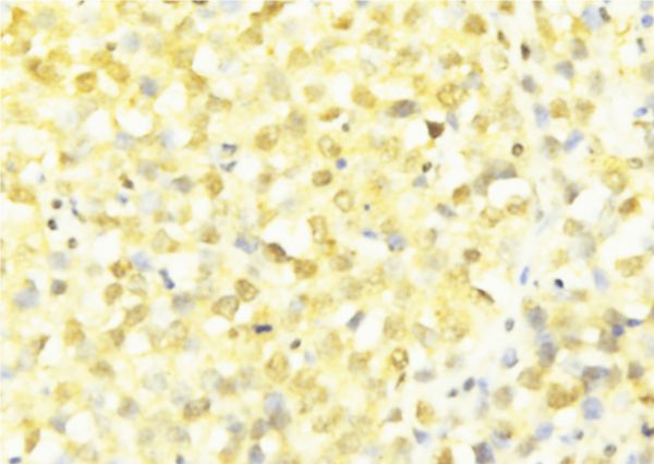HNRNPF / hnRNP F Antibody - 1:100 staining human breast carcinoma tissue by IHC-P. The sample was formaldehyde fixed and a heat mediated antigen retrieval step in citrate buffer was performed. The sample was then blocked and incubated with the antibody for 1.5 hours at 22°C. An HRP conjugated goat anti-rabbit antibody was used as the secondary.