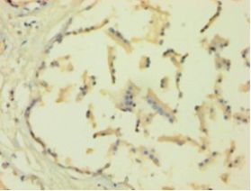 HNRNPH1 / hnRNP H Antibody - Immunohistochemistry of paraffin-embedded human cervical cancer tissue using antibody at 1:100 dilution.  This image was taken for the unconjugated form of this product. Other forms have not been tested.