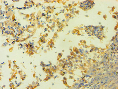 HNRNPH1 / hnRNP H Antibody - Immunohistochemistry of paraffin-embedded human cervical cancer using HNRNPH1 Antibody at dilution of 1:100