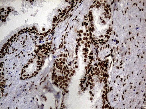 HNRNPH1 / hnRNP H Antibody - Immunohistochemical staining of paraffin-embedded Human prostate tissue within the normal limits using anti-HNRNPH1 mouse monoclonal antibody. (Heat-induced epitope retrieval by 1mM EDTA in 10mM Tris buffer. (pH8.5) at 120°C for 3 min. (1:500)