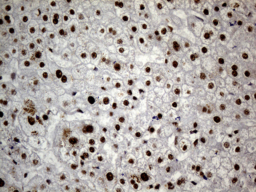 HNRNPH1 / hnRNP H Antibody - Immunohistochemical staining of paraffin-embedded Human liver tissue within the normal limits using anti-HNRNPH1 mouse monoclonal antibody. (Heat-induced epitope retrieval by 1mM EDTA in 10mM Tris buffer. (pH8.5) at 120°C for 3 min. (1:500)
