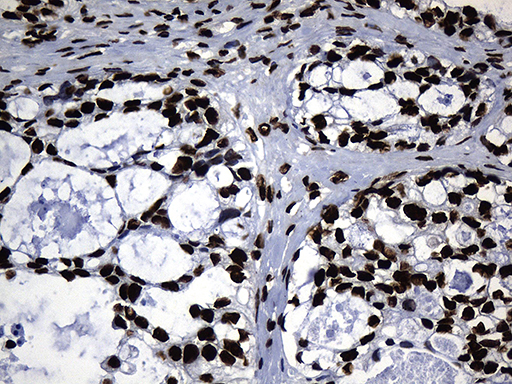 HNRNPH1 / hnRNP H Antibody - Immunohistochemical staining of paraffin-embedded Adenocarcinoma of Human ovary tissue using anti-HNRNPH1 mouse monoclonal antibody. (Heat-induced epitope retrieval by 1mM EDTA in 10mM Tris buffer. (pH8.5) at 120°C for 3 min. (1:500)