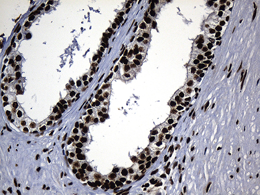 HNRNPH1 / hnRNP H Antibody - Immunohistochemical staining of paraffin-embedded Carcinoma of Human prostate tissue using anti-HNRNPH1 mouse monoclonal antibody. (Heat-induced epitope retrieval by 1mM EDTA in 10mM Tris buffer. (pH8.5) at 120°C for 3 min. (1:500)