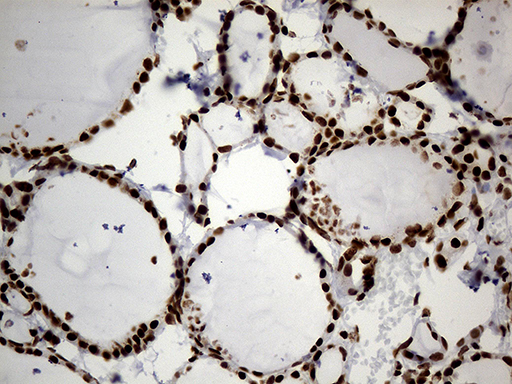 HNRNPH1 / hnRNP H Antibody - Immunohistochemical staining of paraffin-embedded Human thyroid tissue within the normal limits using anti-HNRNPH1 mouse monoclonal antibody. (Heat-induced epitope retrieval by 1mM EDTA in 10mM Tris buffer. (pH8.5) at 120°C for 3 min. (1:500)