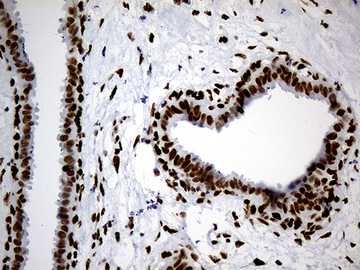 HNRNPH1 / hnRNP H Antibody - Immunohistochemical staining of paraffin-embedded Human breast tissue within the normal limits using anti-HNRNPH1 mouse monoclonal antibody. (Heat-induced epitope retrieval by 1mM EDTA in 10mM Tris buffer. (pH8.5) at 120°C for 3 min. (1:500)