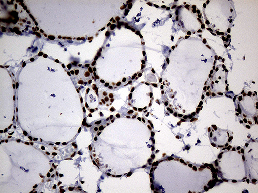 HNRNPH1 / hnRNP H Antibody - Immunohistochemical staining of paraffin-embedded Human thyroid tissue within the normal limits using anti-HNRNPH1 mouse monoclonal antibody. (Heat-induced epitope retrieval by 1mM EDTA in 10mM Tris buffer. (pH8.5) at 120°C for 3 min. (1:500)