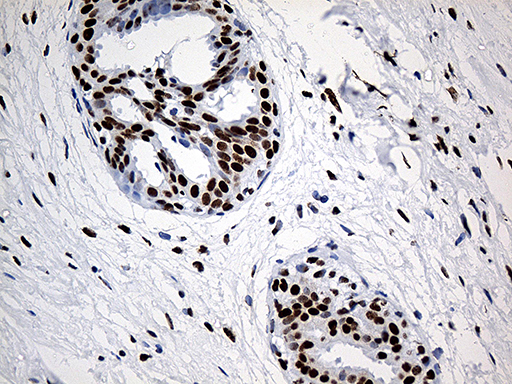 HNRNPH1 / hnRNP H Antibody - Immunohistochemical staining of paraffin-embedded Human breast tissue within the normal limits using anti-HNRNPH1 mouse monoclonal antibody. (Heat-induced epitope retrieval by 1mM EDTA in 10mM Tris buffer. (pH8.5) at 120°C for 3 min. (1:500)