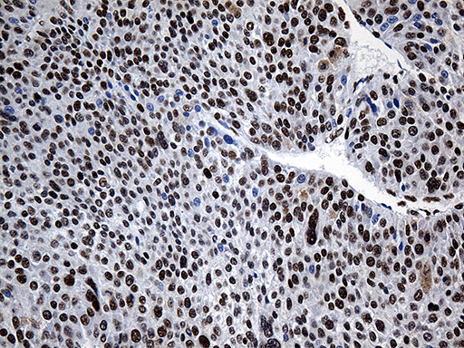 HNRNPH1 / hnRNP H Antibody - Immunohistochemical staining of paraffin-embedded Carcinoma of Human lung tissue using anti-HNRNPH1 mouse monoclonal antibody. (Heat-induced epitope retrieval by 1mM EDTA in 10mM Tris buffer. (pH8.5) at 120°C for 3 min. (1:500)