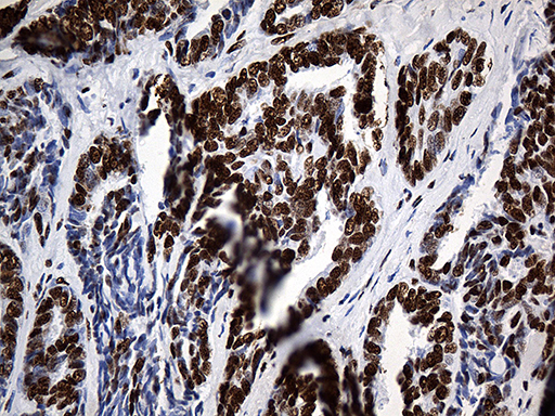 HNRNPH1 / hnRNP H Antibody - Immunohistochemical staining of paraffin-embedded Adenocarcinoma of Human ovary tissue using anti-HNRNPH1 mouse monoclonal antibody. (Heat-induced epitope retrieval by 1mM EDTA in 10mM Tris buffer. (pH8.5) at 120°C for 3 min. (1:500)