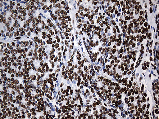 HNRNPH1 / hnRNP H Antibody - Immunohistochemical staining of paraffin-embedded Adenocarcinoma of Human breast tissue tissue using anti-HNRNPH1 mouse monoclonal antibody. (Heat-induced epitope retrieval by 1mM EDTA in 10mM Tris buffer. (pH8.5) at 120°C for 3 min. (1:500)