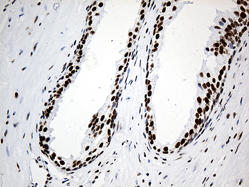 HNRNPH1 / hnRNP H Antibody - Immunohistochemical staining of paraffin-embedded Carcinoma of Human prostate tissue using anti-HNRNPH1 mouse monoclonal antibody. (Heat-induced epitope retrieval by 1mM EDTA in 10mM Tris buffer. (pH8.5) at 120°C for 3 min. (1:500)