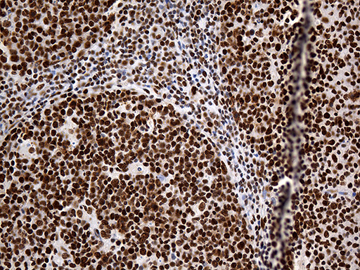 HNRNPH1 / hnRNP H Antibody - Immunohistochemical staining of paraffin-embedded Human tonsil within the normal limits using anti-HNRNPH1 mouse monoclonal antibody. (Heat-induced epitope retrieval by 1mM EDTA in 10mM Tris buffer. (pH8.5) at 120°C for 3 min. (1:500)