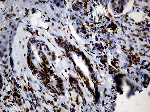 HNRNPH1 / hnRNP H Antibody - Immunohistochemical staining of paraffin-embedded Adenocarcinoma of Human colon tissue using anti-HNRNPH1 mouse monoclonal antibody. (Heat-induced epitope retrieval by 1mM EDTA in 10mM Tris buffer. (pH8.5) at 120°C for 3 min. (1:500)