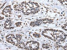 HNRNPH2 / hnRNP H2 Antibody - Immunohistochemistry of paraffin-embedded Human esophagus cancer tissue  using HNRNPH2 Polyclonal Antibody at dilution of 1:40(×200)