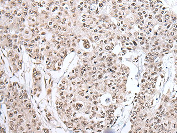 HNRNPH2 / hnRNP H2 Antibody - Immunohistochemistry of paraffin-embedded Human prost ate cancer tissue  using HNRNPH2 Polyclonal Antibody at dilution of 1:40(×200)
