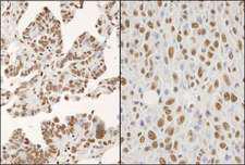 HNRNPK / hnRNP K Antibody - Detection of Human and Mouse hnRNP-K by Immunohistochemistry. Sample: FFPE section of human ovarian carcinoma (left) and mouse squamous cell carcinoma (right). Antibody: Affinity purified rabbit anti-hnRNP-K used at a dilution of 1:1000 (0.2 Detection: DAB.