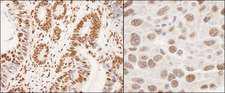 HNRNPK / hnRNP K Antibody - Detection of Human and Mouse hnRNP-K by Immunohistochemistry. Sample: FFPE section of human colon carcinoma (left) and mouse squamous cell carcinoma (right). Antibody: Affinity purified rabbit anti-hnRNP-K used at a dilution of 1:200 (1and 1:1000 (0.2 Detection: DAB.