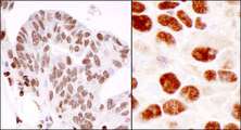 HNRNPK / hnRNP K Antibody - Detection of Human and Mouse hnRNP-K by Immunohistochemistry. Sample: FFPE section of human ovarian carcinoma (left) and mouse squamous cell carcinoma (right). Antibody: Affinity purified rabbit anti-hnRNP-K used at a dilution of 1:1000 (0.2 Detection: DAB.