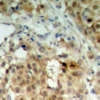 HNRNPK / hnRNP K Antibody - Immunohistochemical analysis of hnRNP K staining in human breast cancer formalin fixed paraffin embedded tissue section. The section was pre-treated using heat mediated antigen retrieval with sodium citrate buffer (pH 6.0). The section was then incubated with the antibody at room temperature and detected using an HRP conjugated compact polymer system. DAB was used as the chromogen. The section was then counterstained with hematoxylin and mounted with DPX.