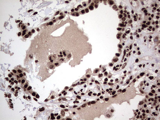 HNRNPL / hnRNP L Antibody - Immunohistochemical staining of paraffin-embedded Carcinoma of Human lung tissue using anti-HNRNPL mouse monoclonal antibody. (Heat-induced epitope retrieval by 1 mM EDTA in 10mM Tris, pH8.5, 120C for 3min,