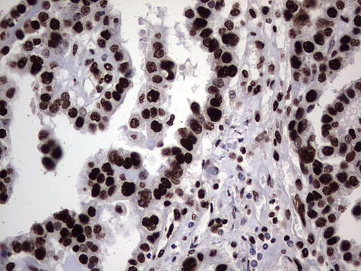 HNRNPL / hnRNP L Antibody - Immunohistochemical staining of paraffin-embedded Adenocarcinoma of Human ovary tissue using anti-HNRNPL mouse monoclonal antibody. (Heat-induced epitope retrieval by 1 mM EDTA in 10mM Tris, pH8.5, 120C for 3min,