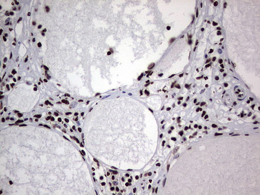 HNRNPL / hnRNP L Antibody - Immunohistochemical staining of paraffin-embedded Human thyroid tissue within the normal limits using anti-HNRNPL mouse monoclonal antibody. (Heat-induced epitope retrieval by 1 mM EDTA in 10mM Tris, pH8.5, 120C for 3min,