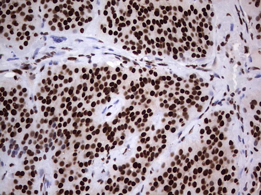 HNRNPL / hnRNP L Antibody - Immunohistochemical staining of paraffin-embedded Carcinoma of Human thyroid tissue using anti-HNRNPL mouse monoclonal antibody. (Heat-induced epitope retrieval by 1 mM EDTA in 10mM Tris, pH8.5, 120C for 3min,