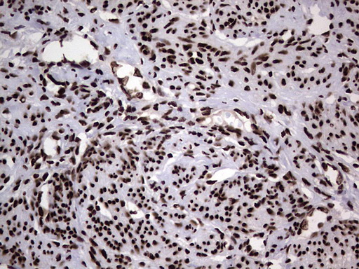 HNRNPL / hnRNP L Antibody - Immunohistochemical staining of paraffin-embedded Human endometrium tissue within the normal limits using anti-HNRNPL mouse monoclonal antibody. (Heat-induced epitope retrieval by 1 mM EDTA in 10mM Tris, pH8.5, 120C for 3min,