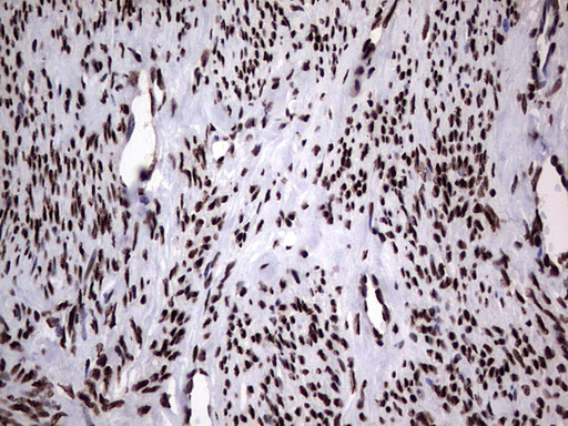 HNRNPL / hnRNP L Antibody - Immunohistochemical staining of paraffin-embedded Adenocarcinoma of Human endometrium tissue using anti-HNRNPL mouse monoclonal antibody. (Heat-induced epitope retrieval by 1 mM EDTA in 10mM Tris, pH8.5, 120C for 3min,