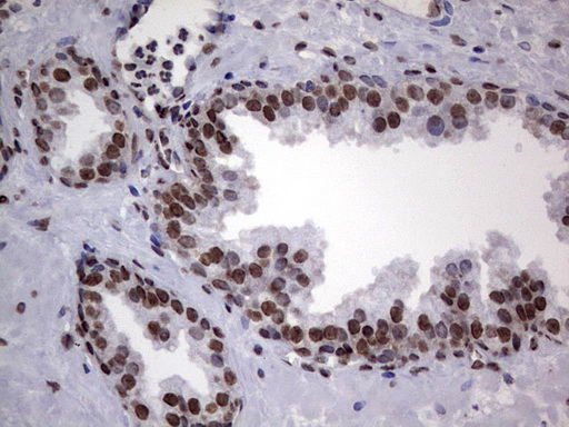 HNRNPL / hnRNP L Antibody - Immunohistochemical staining of paraffin-embedded Carcinoma of Human prostate tissue using anti-HNRNPL mouse monoclonal antibody. (Heat-induced epitope retrieval by 1 mM EDTA in 10mM Tris, pH8.5, 120C for 3min,