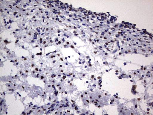 HNRNPL / hnRNP L Antibody - Immunohistochemical staining of paraffin-embedded Human bladder tissue within the normal limits using anti-HNRNPL mouse monoclonal antibody. (Heat-induced epitope retrieval by 1 mM EDTA in 10mM Tris, pH8.5, 120C for 3min,