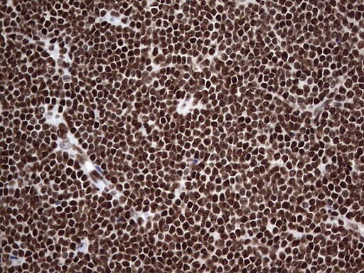 HNRNPL / hnRNP L Antibody - Immunohistochemical staining of paraffin-embedded Human lymphoma tissue using anti-HNRNPL mouse monoclonal antibody. (Heat-induced epitope retrieval by 1 mM EDTA in 10mM Tris, pH8.5, 120C for 3min,