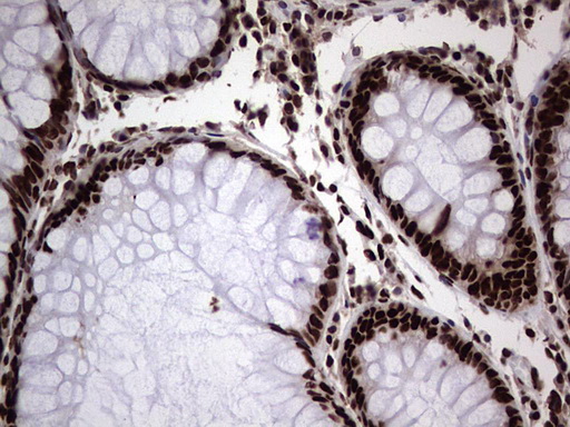 HNRNPL / hnRNP L Antibody - Immunohistochemical staining of paraffin-embedded Human colon tissue within the normal limits using anti-HNRNPL mouse monoclonal antibody. (Heat-induced epitope retrieval by 1 mM EDTA in 10mM Tris, pH8.5, 120C for 3min,