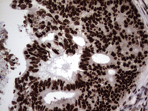 HNRNPL / hnRNP L Antibody - Immunohistochemical staining of paraffin-embedded Adenocarcinoma of Human colon tissue using anti-HNRNPL mouse monoclonal antibody. (Heat-induced epitope retrieval by 1 mM EDTA in 10mM Tris, pH8.5, 120C for 3min,