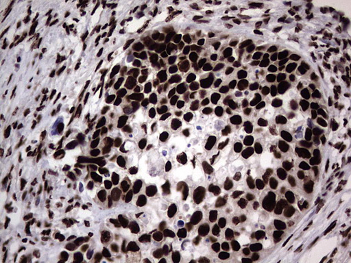 HNRNPL / hnRNP L Antibody - IHC of paraffin-embedded Carcinoma of Human kidney tissue using anti-HNRNPL mouse monoclonal antibody. (Heat-induced epitope retrieval by 1 mM EDTA in 10mM Tris, pH8.5, 120°C for 3min).