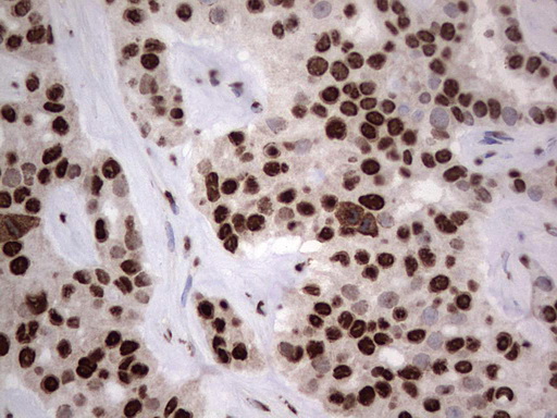 HNRNPL / hnRNP L Antibody - IHC of paraffin-embedded Carcinoma of Human liver tissue using anti-HNRNPL mouse monoclonal antibody. (Heat-induced epitope retrieval by 1 mM EDTA in 10mM Tris, pH8.5, 120°C for 3min).