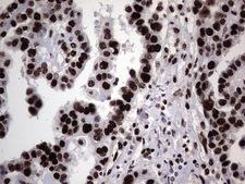 HNRNPL / hnRNP L Antibody - IHC of paraffin-embedded Adenocarcinoma of Human ovary tissue using anti-HNRNPL mouse monoclonal antibody. (Heat-induced epitope retrieval by 1 mM EDTA in 10mM Tris, pH8.5, 120°C for 3min).