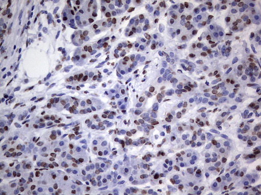 HNRNPL / hnRNP L Antibody - IHC of paraffin-embedded Carcinoma of Human pancreas tissue using anti-HNRNPL mouse monoclonal antibody. (Heat-induced epitope retrieval by 1 mM EDTA in 10mM Tris, pH8.5, 120°C for 3min).